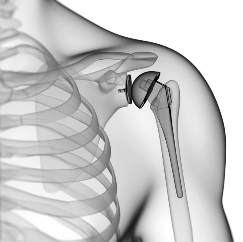 marco spoliti primario san camillo forlanini - ortopedico specializzato nella spalla